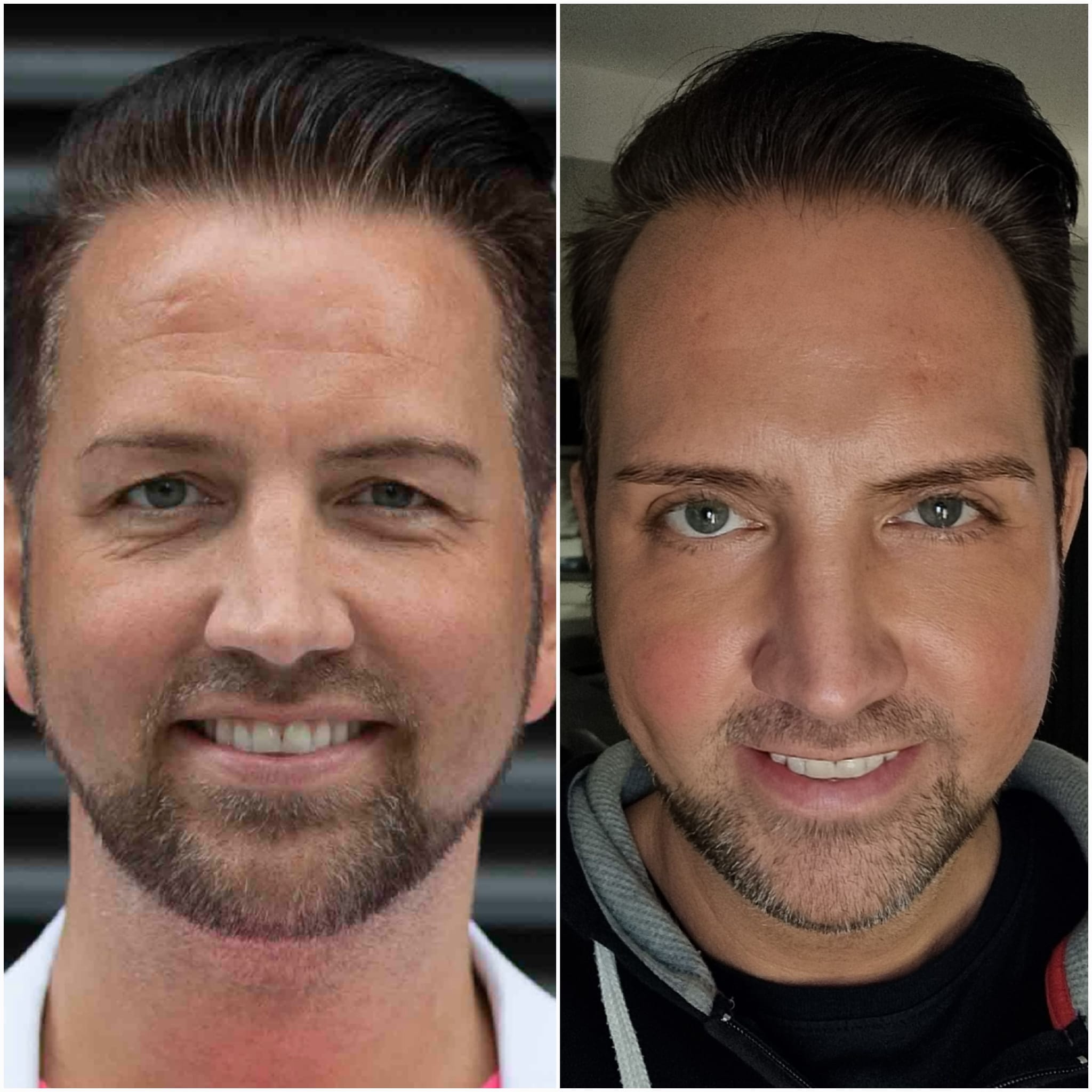 NEON-Mitglied Andi vor und nach der OP